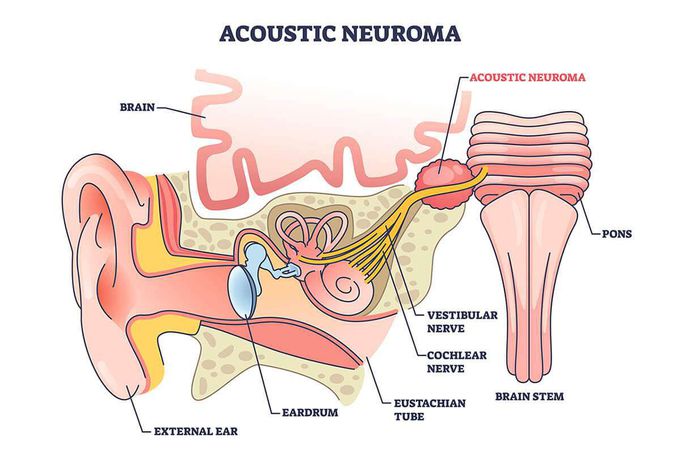 What are the symptoms of acoustic neuroma?