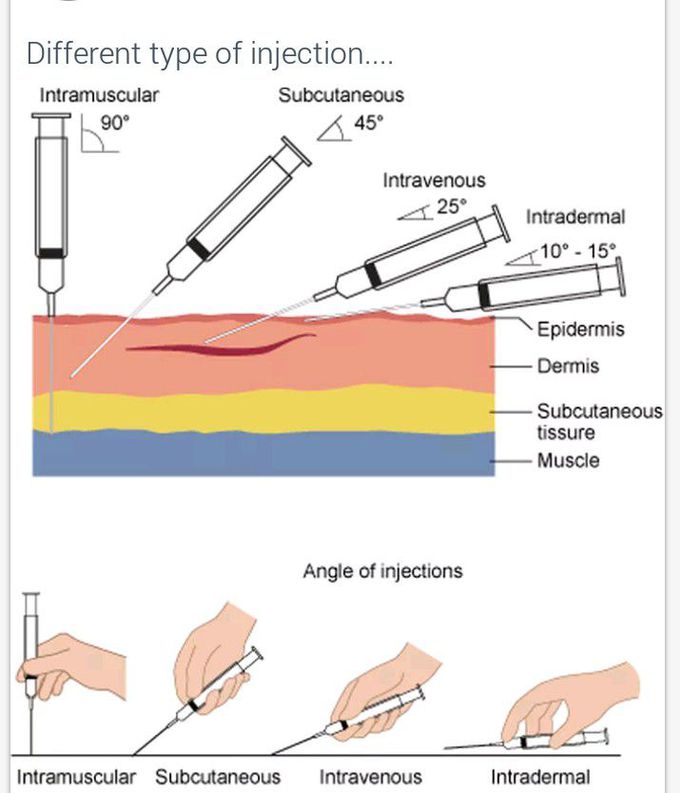 Angle of injections
