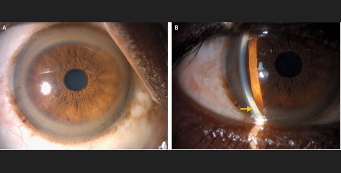 Copper 'rings' inside man's eyes