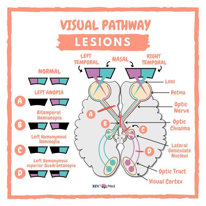 Lesions along the Visual Pathway!