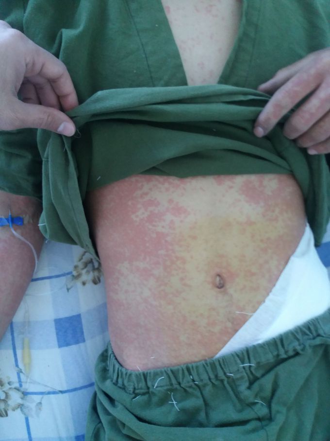 Acute allergic reaction after novacain