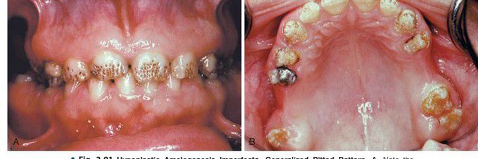 Hypoplastic Amelogenesis Imperfecta, Generalized Pitted Pattern