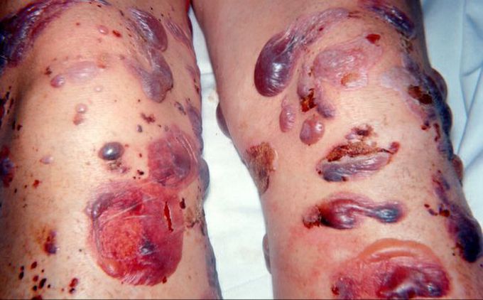 PEMPHIGUS VULGARIS