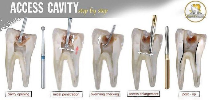 Access Cavity