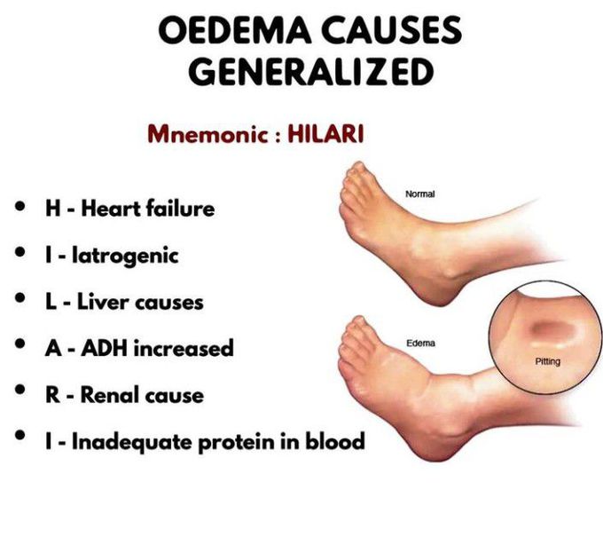 Generalized Edema MEDizzy