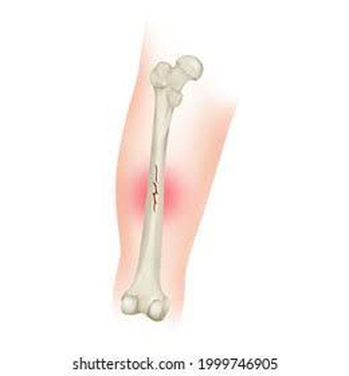 linear bone fracture