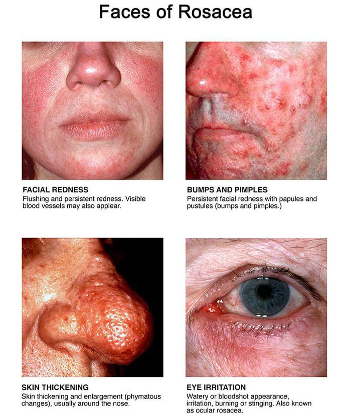 Rosacea