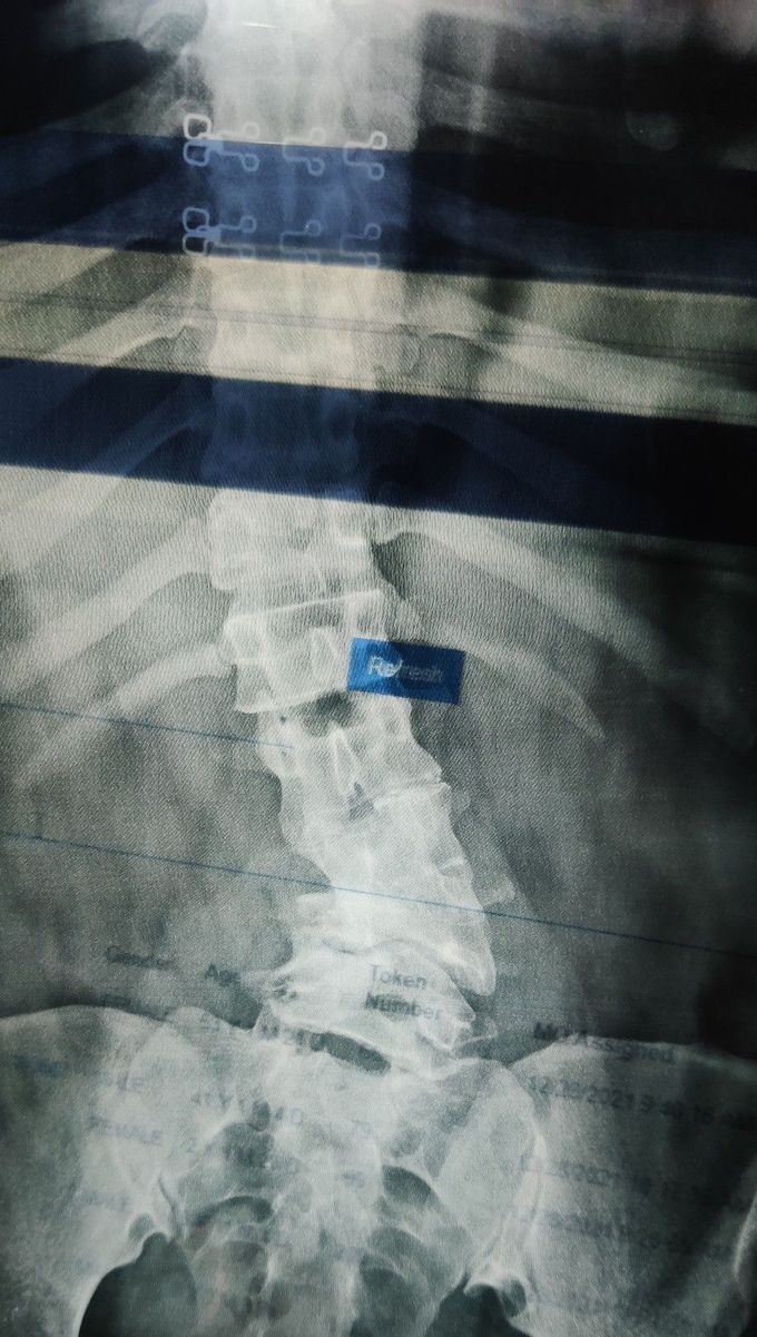 Scoliosis