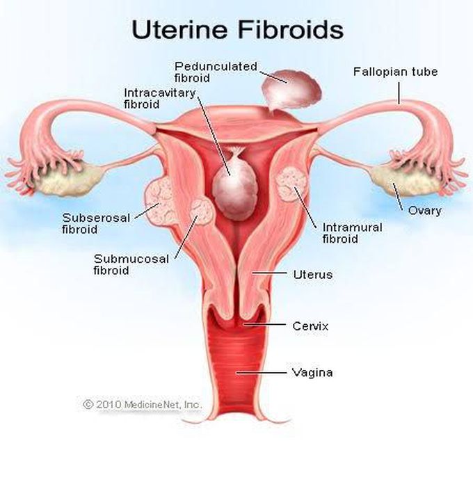 Treatment of fibroids