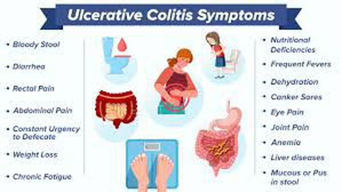 Symptoms of ulcerative colitis - MEDizzy