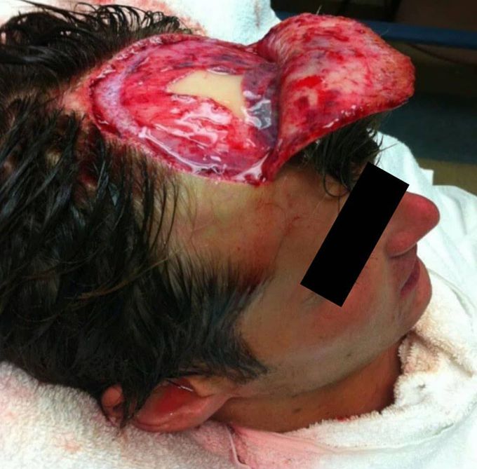⚠️ Horrible head injury while whitewater rafting! 