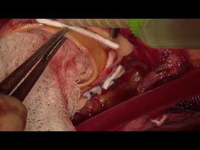 Type A Aortic Dissection With Hemi Arch Replacement