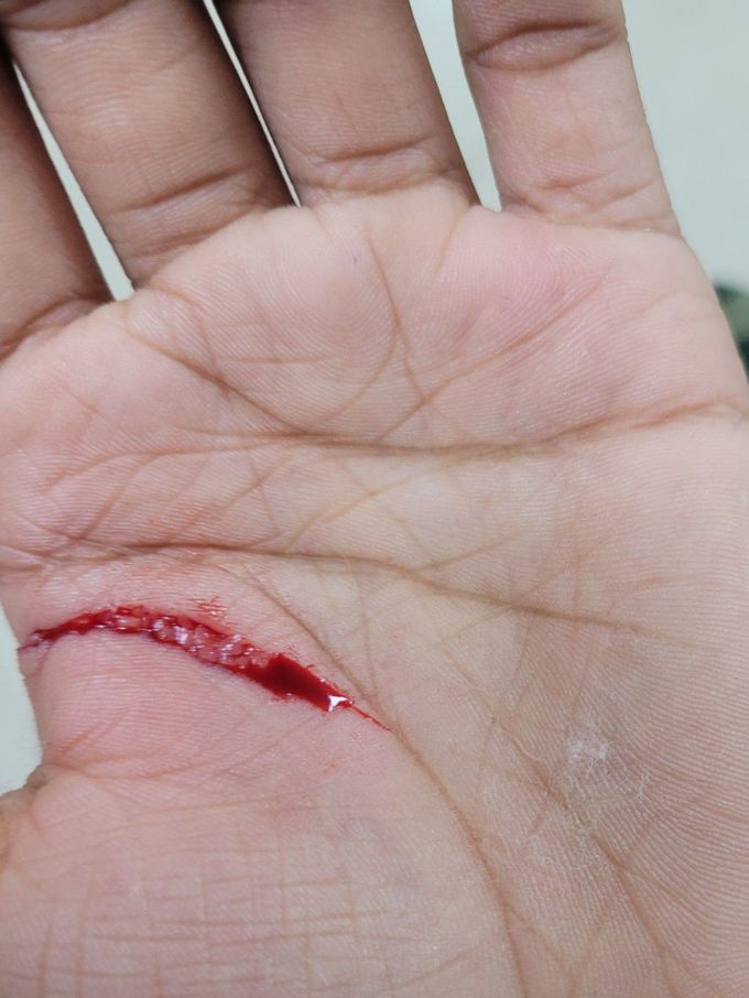 Incision By Knife