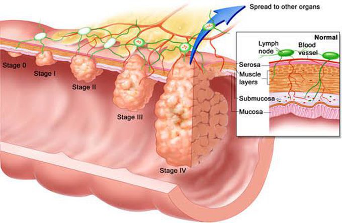 Proctitis