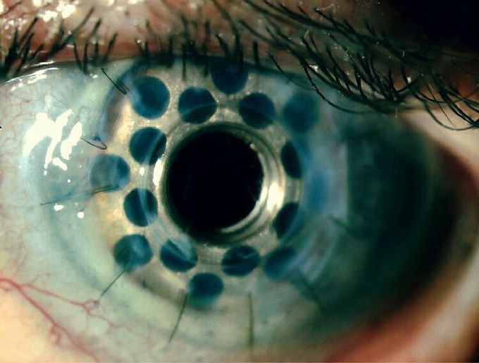 Artificial cornea replacment (Keratoprosthesis) When a - MEDizzy