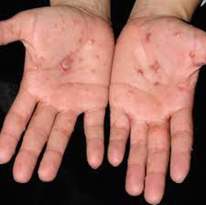 Tinea corporis - MEDizzy