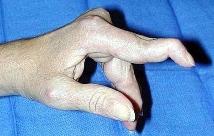 Swan-neck deformity