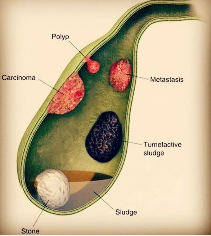 Gall Bladder stones