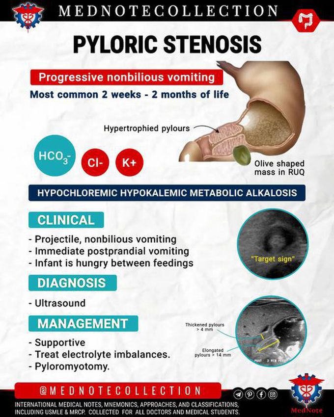 🧠 PYLORIC STENOSIS