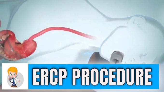ERCP (Endoscopic Retrograde Cholangiopancreatography): procedure in 3D