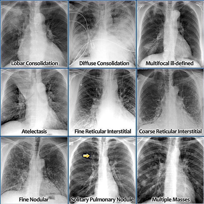 Chest Xray Radiographs
