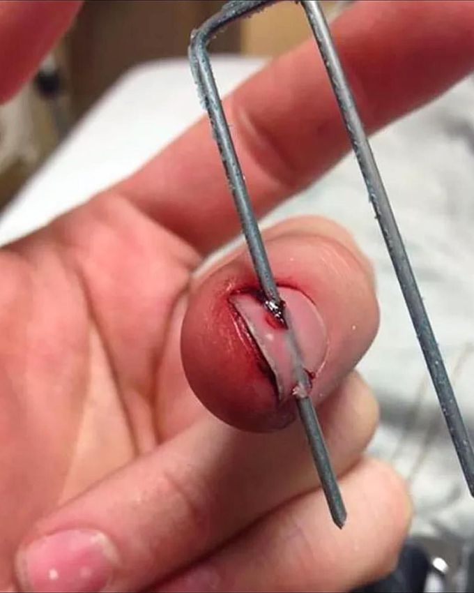 Giant air heavy duty staple gun injury penetrated through the nail! 