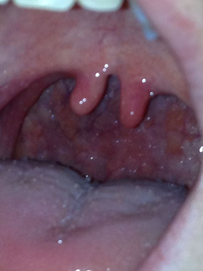 Bifid uvulva