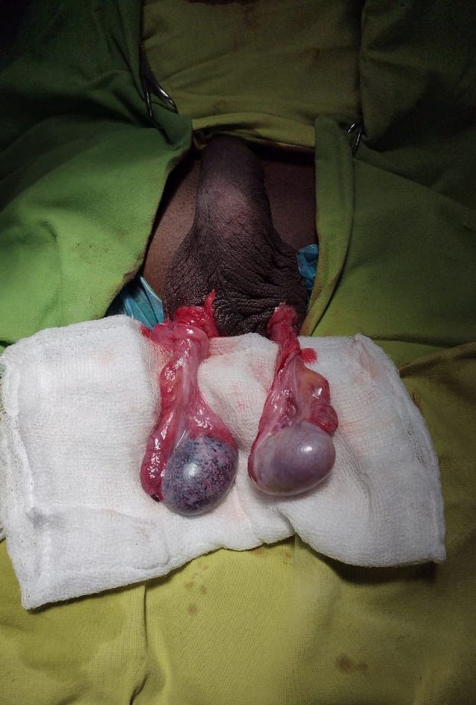 Orchidectomy