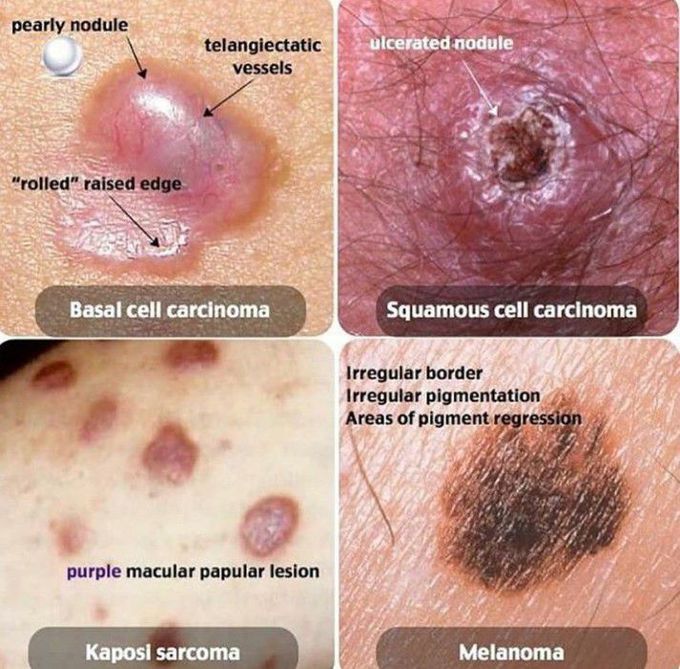 Cancers/Malignancies