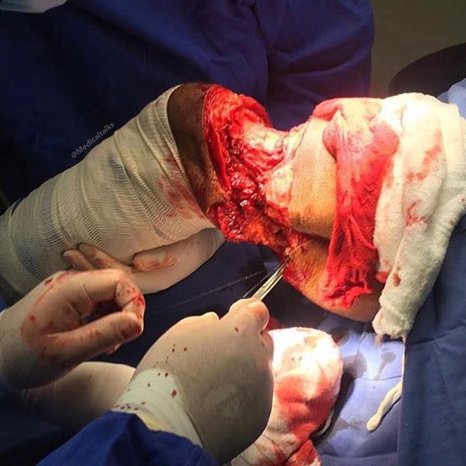 Above-the-knee leg amputation