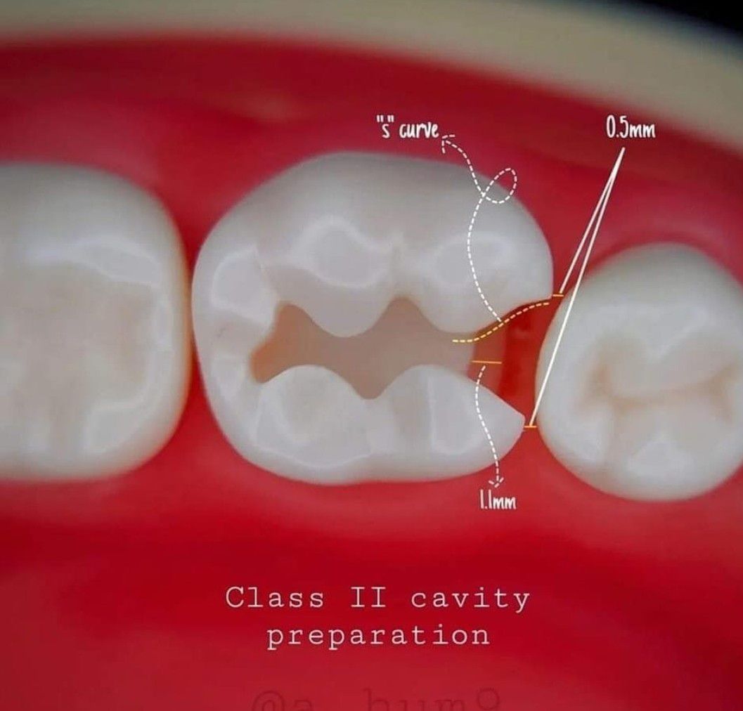 Class II Cavity Prep - MEDizzy