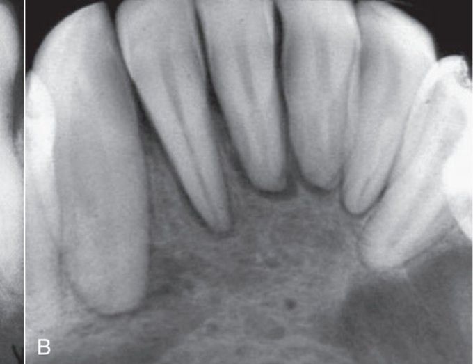 Hyperparathyroidism