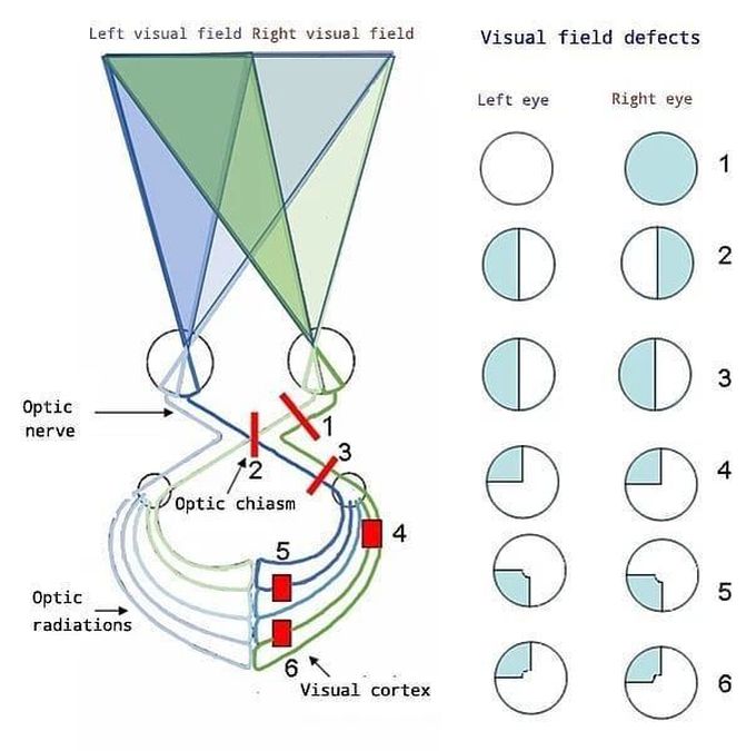 Visual Field Defect