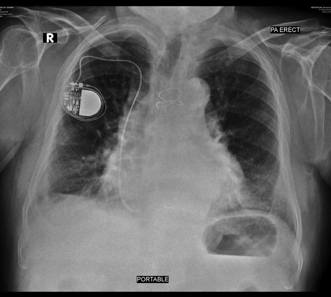 Old age pneumonia