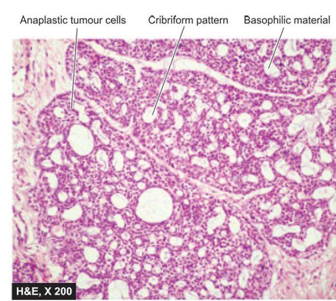 Adenoid cystic carcinoma.