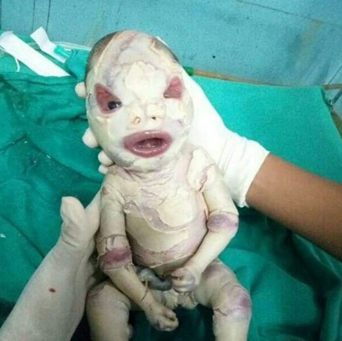 Harlequin Icthyosis