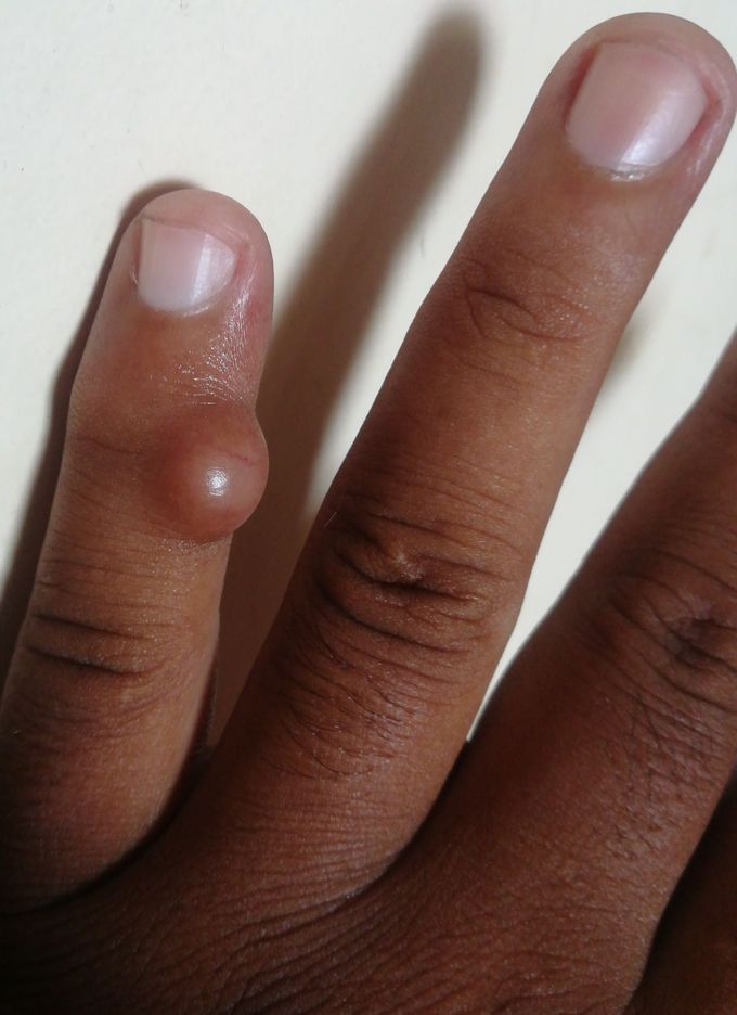 Pt come with the histroy of pain and sweeling in the fingure