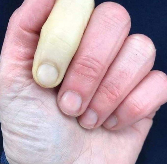 Raynaud's Phenomenon !!