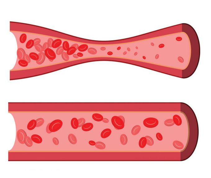 Variant Angina