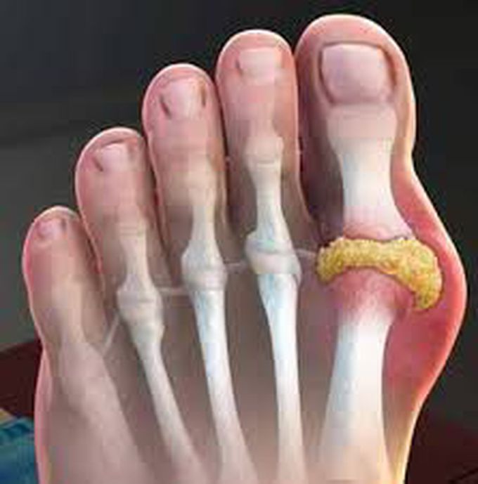What causes gout?