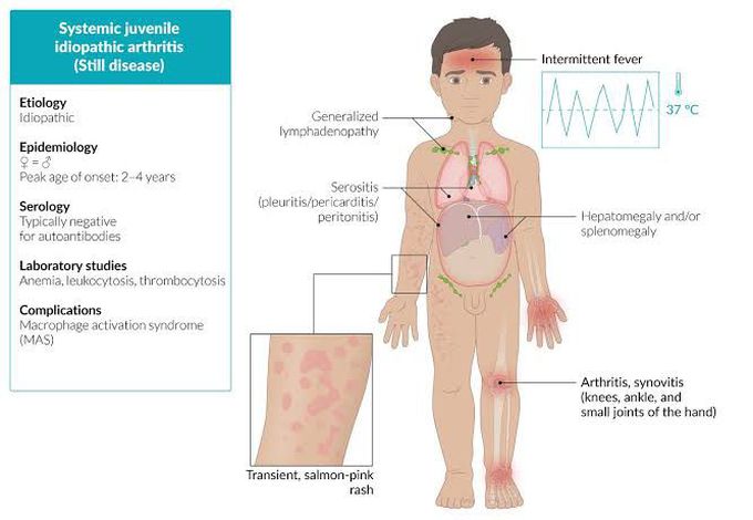 Systemic Juvenile Idiopathic Arthritis