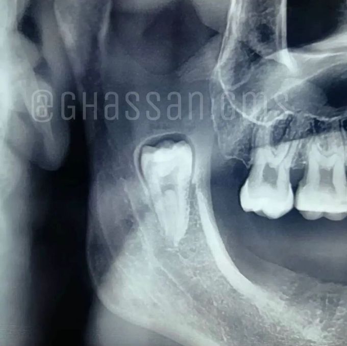 An impacted wisdom tooth