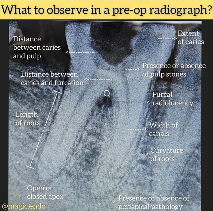 Pre-Op Radiograph