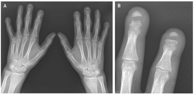 Band Acro-osteolysis