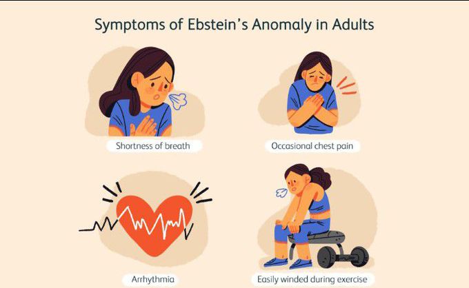 Symptom of Ebstein anomaly