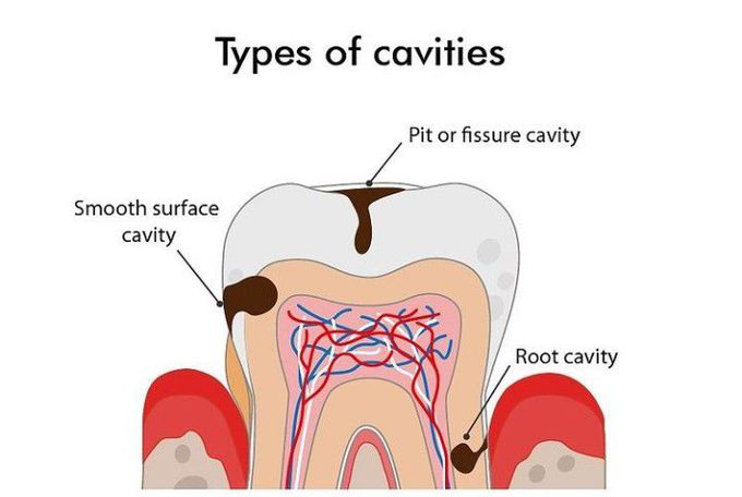 Types of cavities