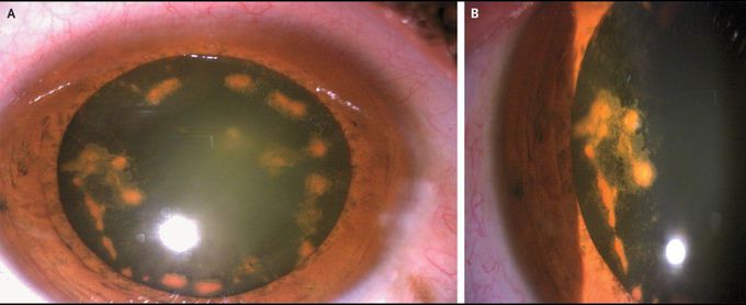 Iron Deposition from a Retained Intraocular Foreign Body