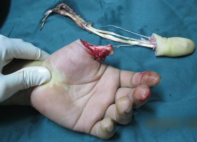 Rotational avulsion of the thumb following a work accident! ⚠️ 