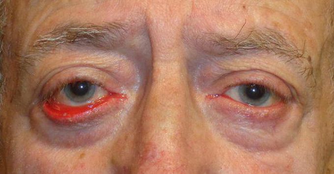 ectropion