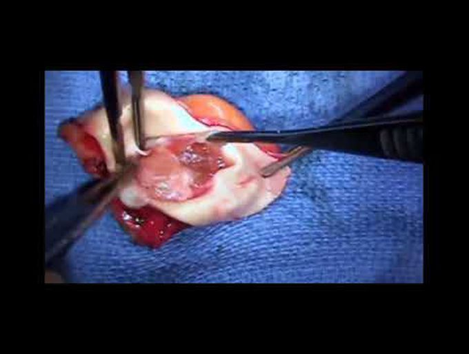 Resection of Pulmonary Artery Trunk Mass